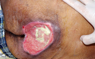 زخم فشاری (زخم بستر)