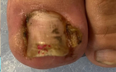 درمان تخصصی فرورفتگی ناخن در گوشت