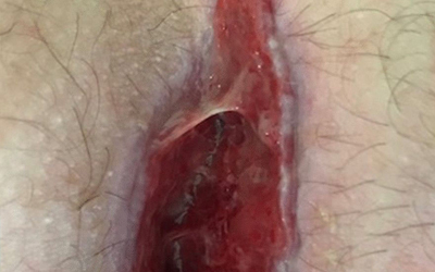 زخم‌های جراحی