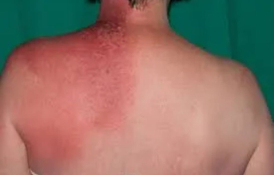 زخم ناشی از رادیوتراپی