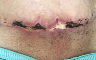 زخم جراحی شکم