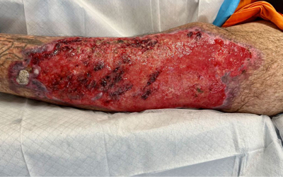 زخم‌های تروما (ضربه‌ای و حادثه‌ای)